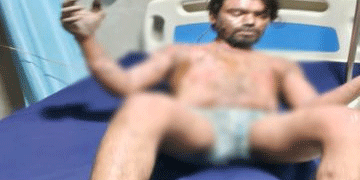 स्पंज आयरन प्लांट में हादसा, पिघला लोहा गिरने से 4 मजदूर झुलसे