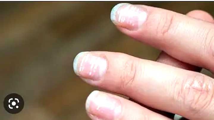 नाखून सिर्फ खूबसूरती नहीं, सेहत का आईना भी हैं; इन बदलावों पर दें ध्यान