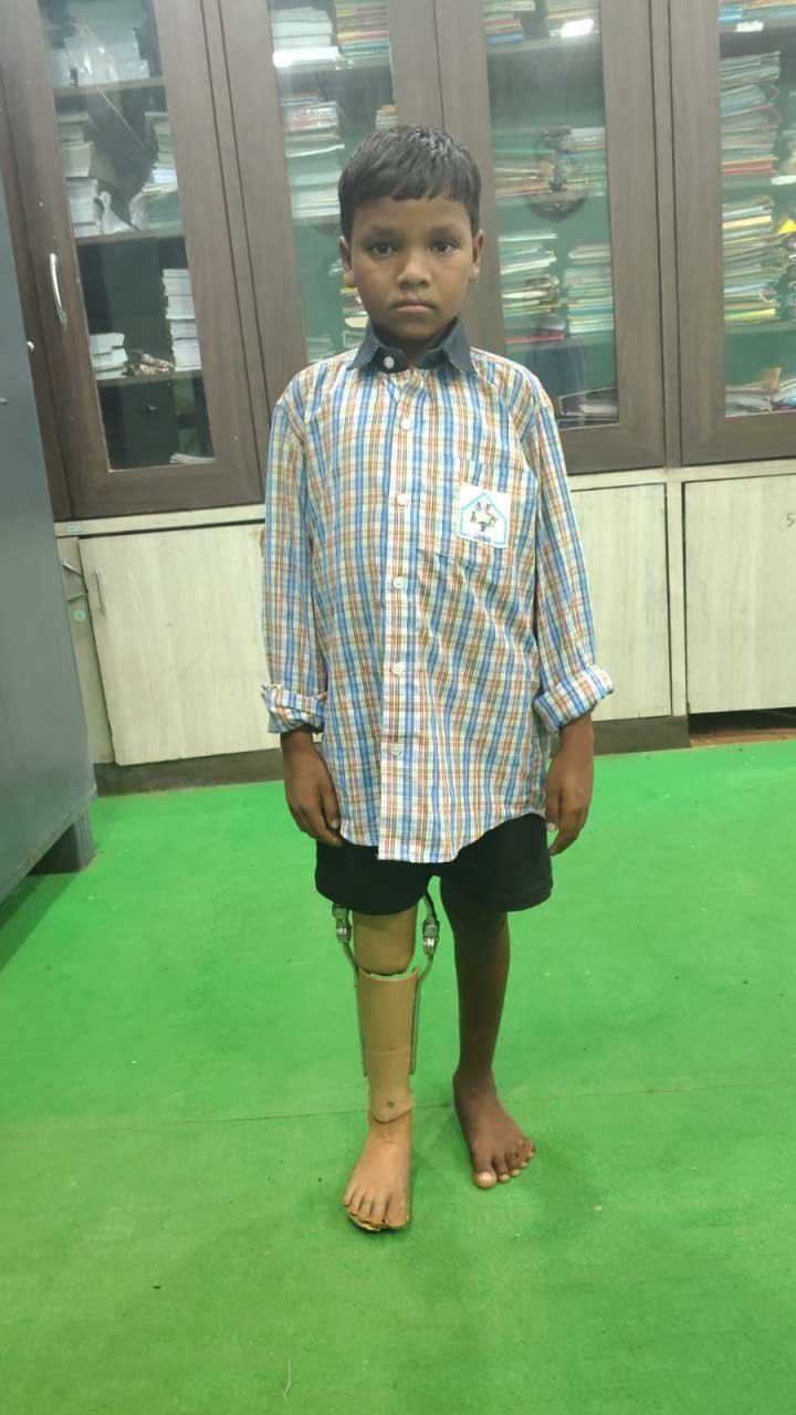  10 साल के कमलेश को मिला कृत्रिम पैर, अब मंजिल की ओर बढ़ेंगे कदम